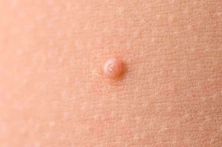 Dermashrii